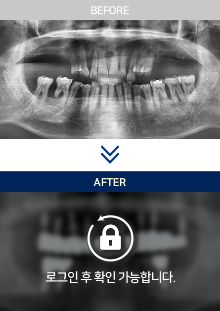 서울더고운치과-치료전후사진01
