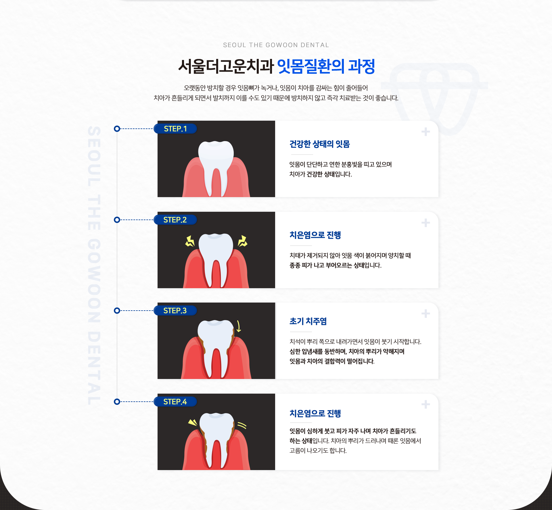 서울더고운치과-잇몸질환의-과정-오랫동안-방치할-경우-잇몸뼈가-녹거나,-잇몸이-치아를-감싸는-힘이-줄어들어-치아가-흔들이게-되면서-발치까지-이를-수도-있기-떄문에-방치하지-않고-즉각-치료-받는-것이-좋습니다.-STEP1-건강한-상태의-잇몸-잇몸과-치아가-건강한-상태입니다.-STEP2-치은염으로-진행-치태가-제거되지-않아-잇몸-색이-붉어지며-양치할-때-종종-피가-나고-부어오르는-상태입니다.-STEP3-초기-치주염-치석이-뿌리-쪽으로-내려가면서-잇몸이-붓기-시작합니다.-심한-입냄새를-동반하며,-치아의-뿌리가-약해지며-잇몸과-치아의-결합력이-떨어집니다.-STPE4-치은염으로-진행-잇몸이-심하게-붓고-피가-자주-나며-치아가-흔들리기도-하는-상태입니다.-치아의-뿌리가-드러나며-때론-잇몸에서-고름이-나오기도-합니다.