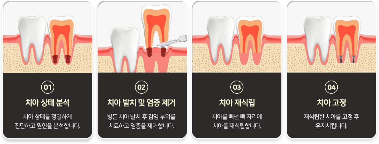 치아재식술 01 치아 상태 분석 치아 상태를 정밀하게 진단하고 원인을 분석합니다. 02 치아 발치 및 염증 제거 병든 치아 발치 후 감염 부위를 치료하고 염증을 제거합니다. 03 치아 재식립 치아를 빼낸 뼈 자리에 치아를 재식립합니다. 04 치아 고정 재식립한 치아를 고정 후 유지시킵니다.