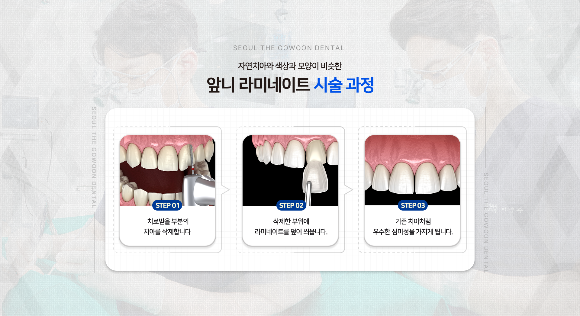 자연치아와-색상과-모양이-비슷한-앞니-라미네이트-시술-과정-STEP01-치료받을-부분의-치아를-삭제합니다.-STEP02-삭제한-부위에-라미네이트를-덮어-씌웁니다.-STEP03-기존-치아처럼-우수한-심미성을-가지게-됩니다.